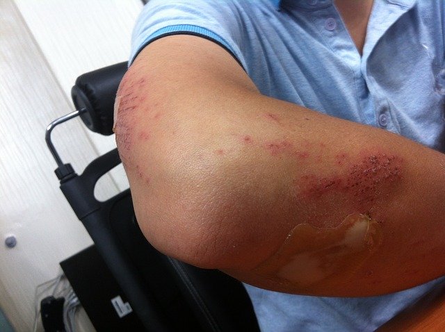 A Person having Skin Infection
